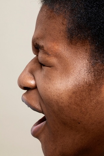 L'acné est une inflammation de la glande pilo-sébacée qui est un organe localisé au niveau du derme. Elle est responsable de la synthèse et de la sécrétion du sébum qui doit protéger la peau des agressions extérieures et de la déshydratation. C’est une maladie chronique de la peau, fréquente chez les sujets adolescents. Elle se manifeste par des lésions qu’on appelle les comédons (ndlr : boutons) ou encore des microkystes qui apparaissent très généralement sur le visage.